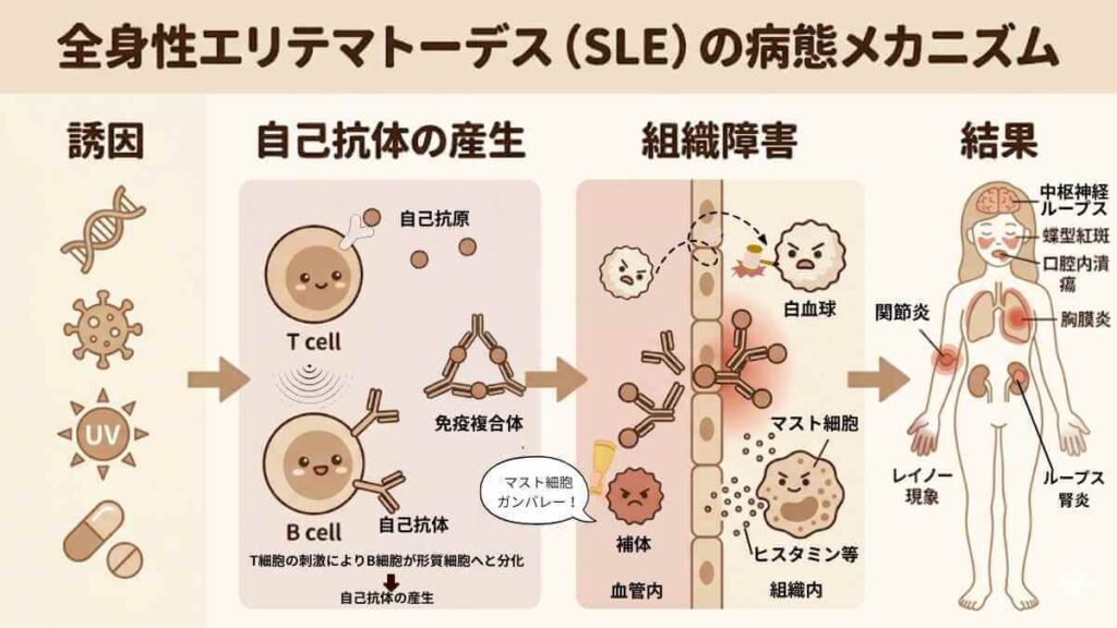 全身性エリテマトーデス（SLE）の病態メカニズム。誘因から自己抗体の産生（T細胞・B細胞）、免疫複合体による組織障害、補体の活性化、そしてループス腎炎や蝶形紅斑などの臨床結果までを説明する図解。