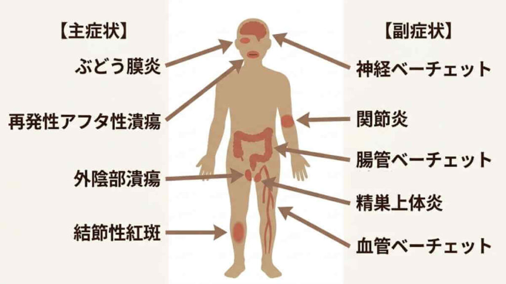 behcets-disease-clinical-symptoms-major-minor